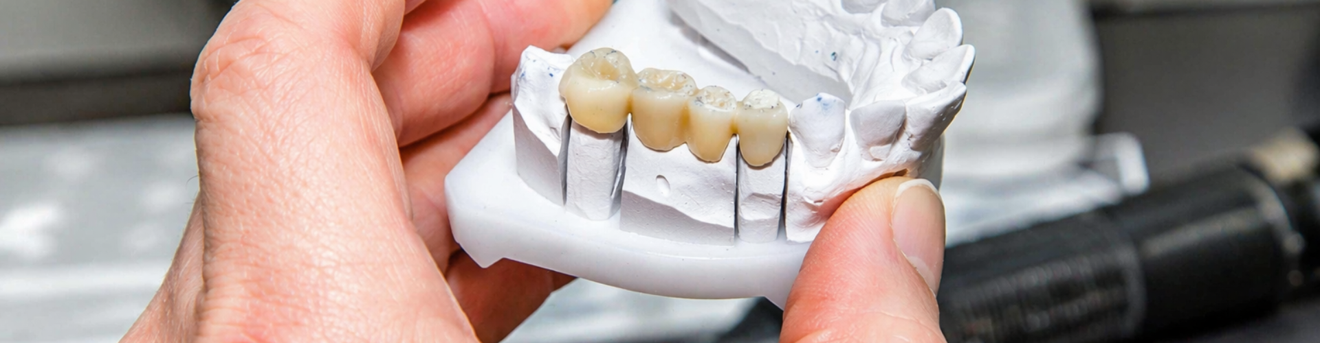 Hand holding plaster mold with dental bridge on teeth.